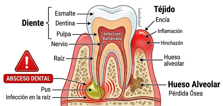 Ilustración médica de advertencia mostrando un diente con absceso dental, zona inflamada en rojo, diagrama educativo de urgencia dental