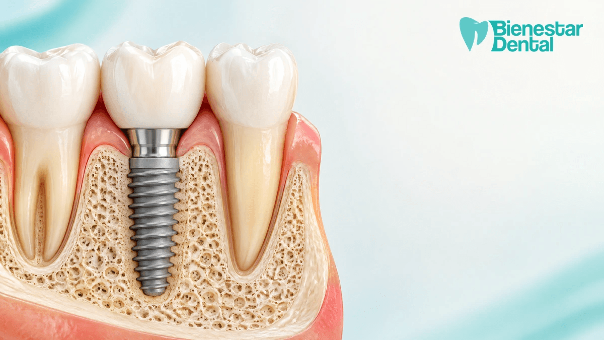 Ilustración médica de implante dental de titanio en corte transversal del hueso mandibular