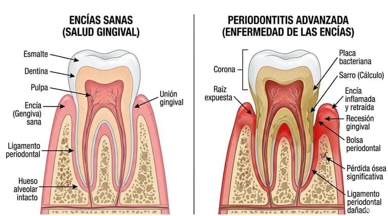 Ilustración médica comparando encías sanas versus periodontitis mostrando recesión gingival y pérdida de hueso, vista en corte transversal de dientes y encías