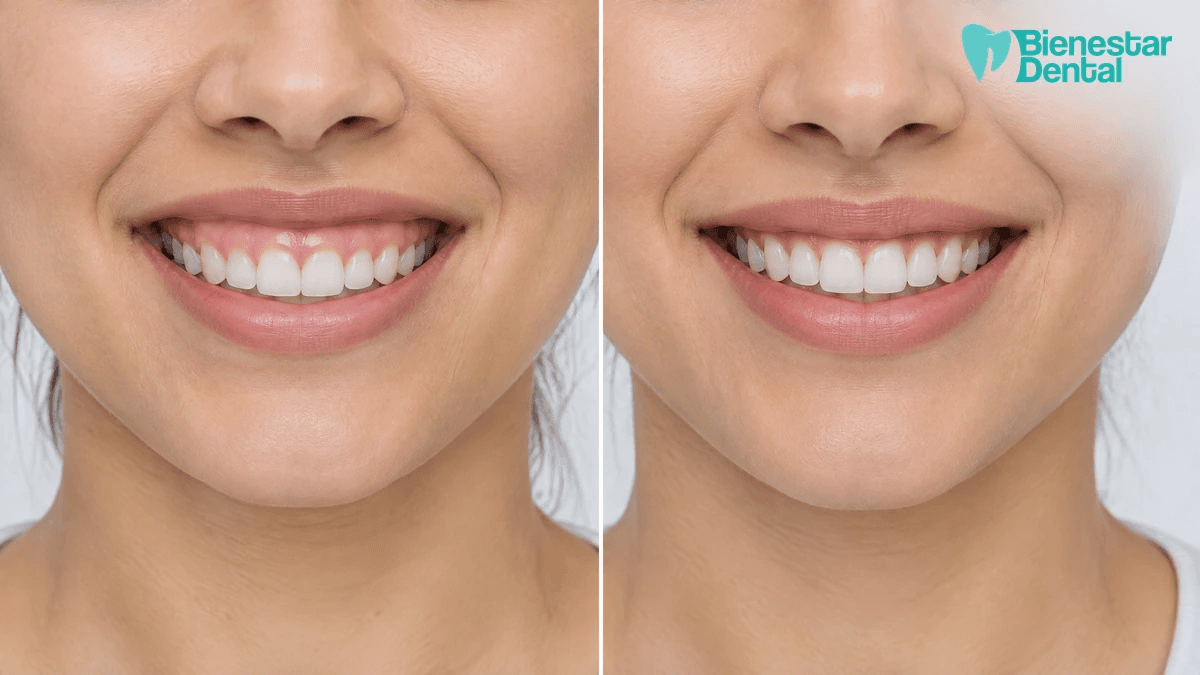 Comparación antes y después de corrección de sonrisa gingival, fotografía de estética dental