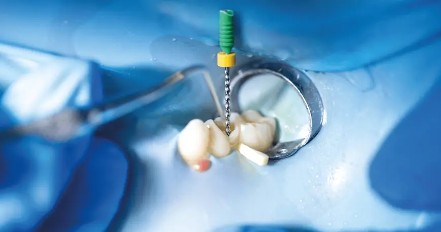 Especialidad en Endodoncia - Bienestar Dental Providencia
