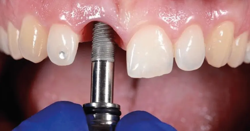 Especialidad en Implantes Dentales - Bienestar Dental Providencia