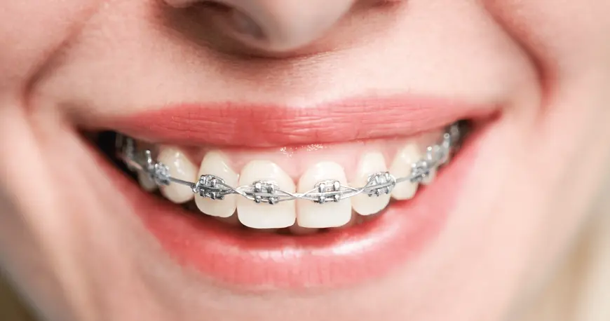 Especialidad en Ortodoncia - Bienestar Dental Providencia