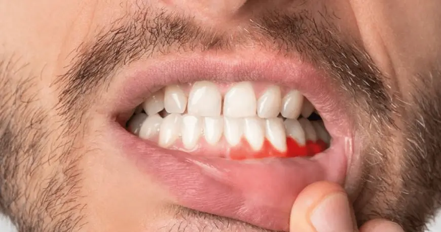 Especialidad en Periodoncia - Bienestar Dental Providencia