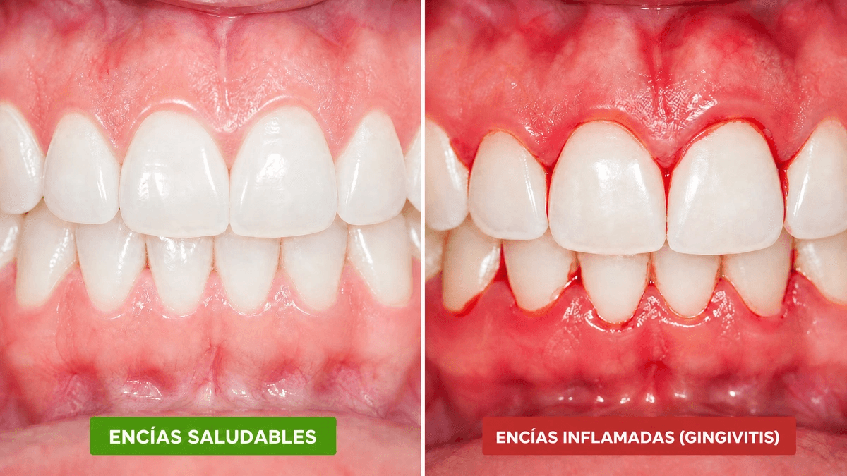 Comparación entre encías sanas de color rosado y encías rojas inflamadas que sangran