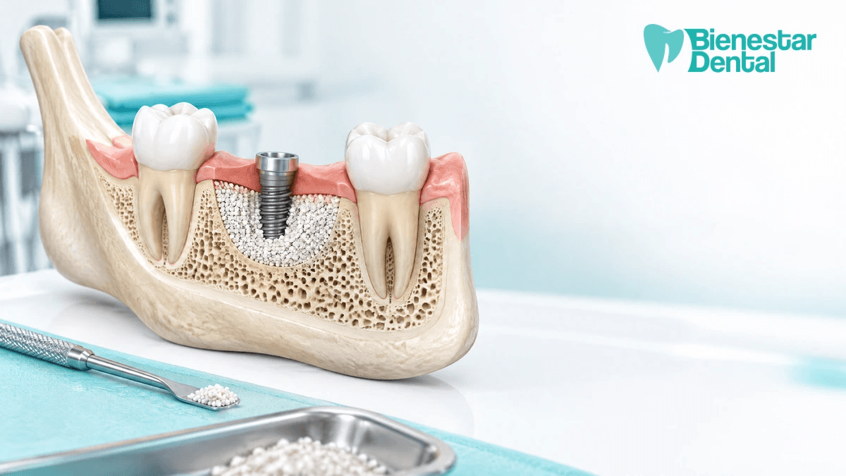 Ilustración médica de injerto óseo dental y regeneración mandibular