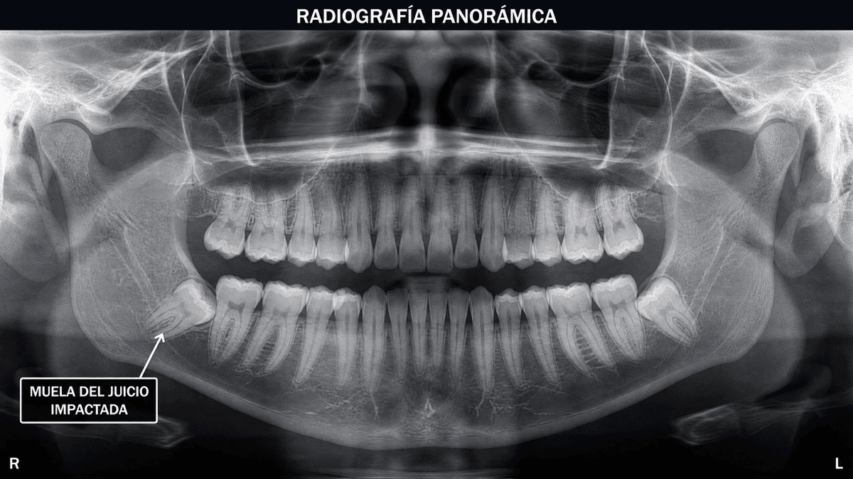 Radiografía panorámica mostrando muela del juicio impactada