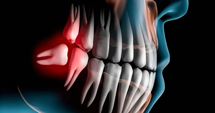 Tratamiento de Cirugía Oral en Bienestar Dental Providencia
