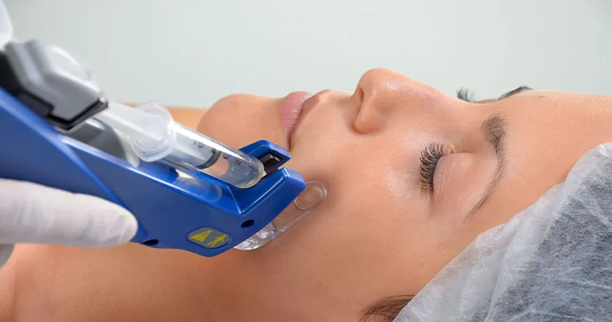 Tratamiento de Mesoterapia Facial en Bienestar Dental Providencia