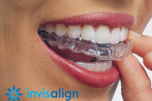 Alineadores removibles Invisalign