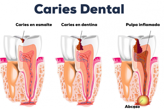 Caries dental