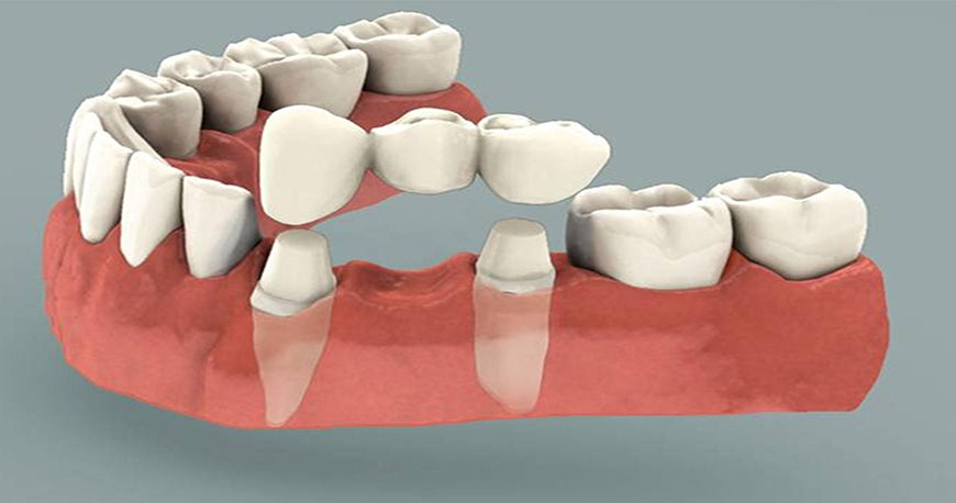 Reemplazo de piezas dentales