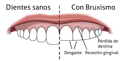 Bruxismo