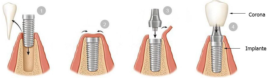 partes de un implante dental